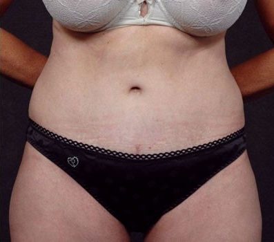 Abdominoplasty after, case 01