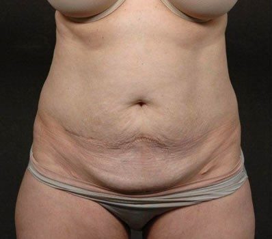 Abdominoplasty before, case 01