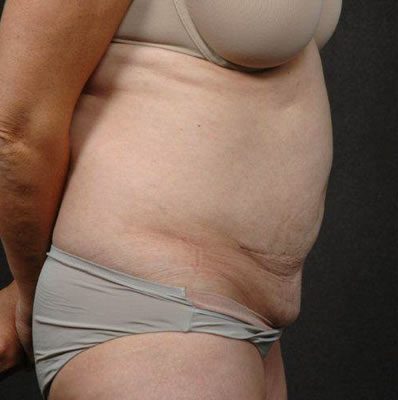 Abdominoplasty before and after, case 01, view 3 (before)