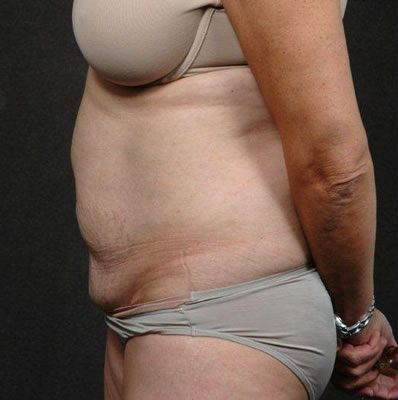 Abdominoplasty before and after, case 01, view 5 (before)