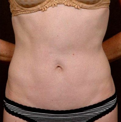 Abdominoplasty after, case 02
