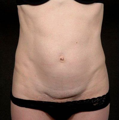Abdominoplasty before, case 02