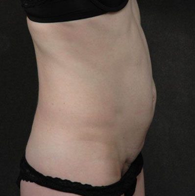 Abdominoplasty before and after, case 02, view 3 (before)