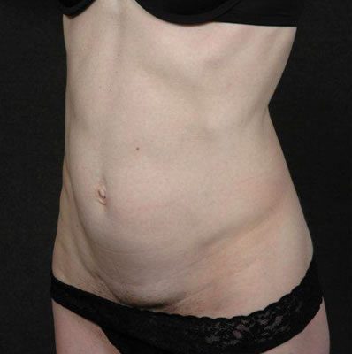 Abdominoplasty before and after, case 02, view 4 (before)