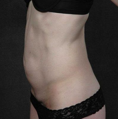 Abdominoplasty before and after, case 02, view 5 (before)