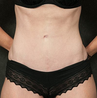 Abdominoplasty after, case 03