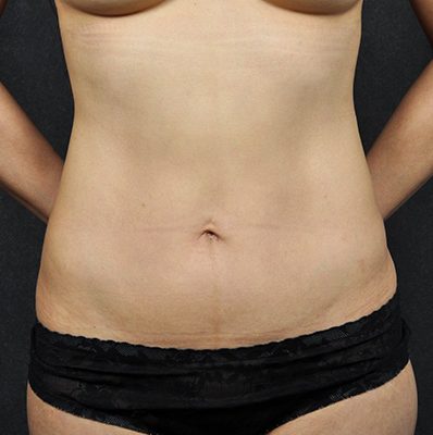 Abdominoplasty after, case 04