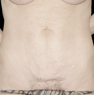 Abdominoplasty before, case 05