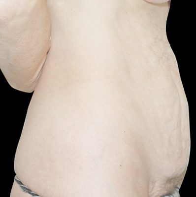 Abdominoplasty before and after, case 05, view 3 (before)