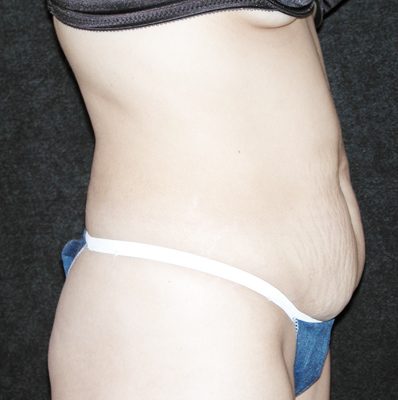 Abdominoplasty before and after, case 07, view 3 (before)