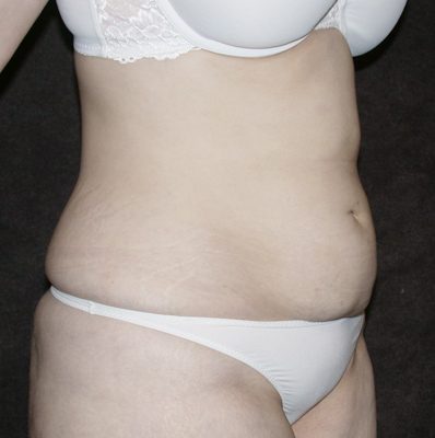 Abdominoplasty before, case 08