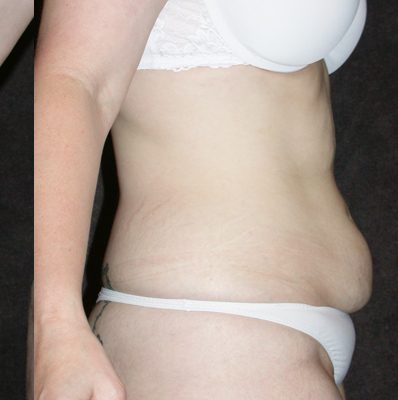 Abdominoplasty before and after, case 08, view 3 (before)