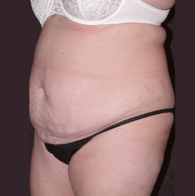 Abdominoplasty before, case 09