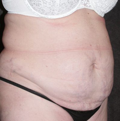 Abdominoplasty before and after, case 09, view 3 (before)