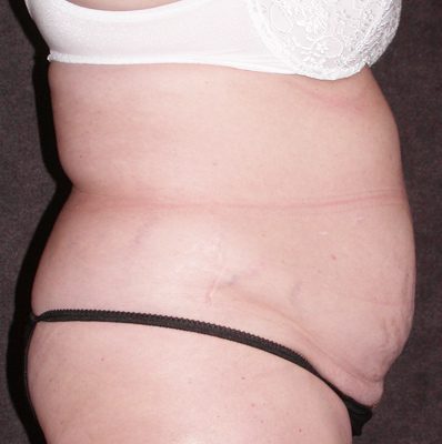 Abdominoplasty before and after, case 09, view 4 (before)