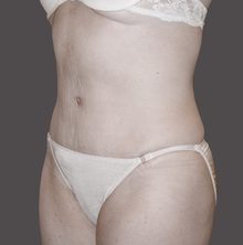 Abdominoplasty before and after, case 11 (after)