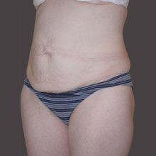 Abdominoplasty before and after, case 11 (before)