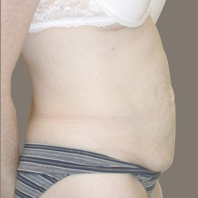 Abdominoplasty before and after, case 11, view 3 (before)