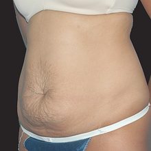 Abdominoplasty before and after, case 12 (before)