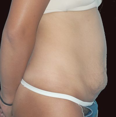 Abdominoplasty before and after, case 12, view 3 (before)