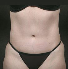 Abdominoplasty before and after, case 13 (after)