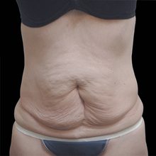 Abdominoplasty before and after, case 13 (before)