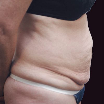 Abdominoplasty before and after, case 13, view 3 (before)