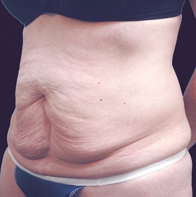 Abdominoplasty before and after, case 13, view 4 (before)