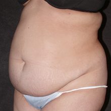 Abdominoplasty before and after, case 14 (before)
