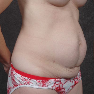 Abdominoplasty before and after, case 15, view 3 (before)