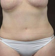 Abdominoplasty before and after, case 16 (after)