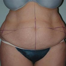 Abdominoplasty before and after, case 16 (before)