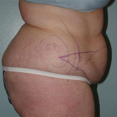 Abdominoplasty before and after, case 16, view 3 (before)