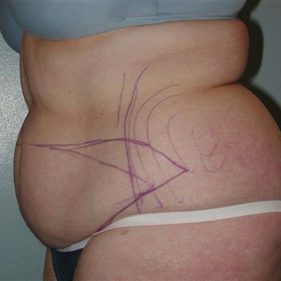 Abdominoplasty before and after, case 16, view 4 (before)