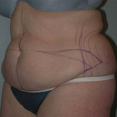 Abdominoplasty before and after, case 16, view 5 (before)