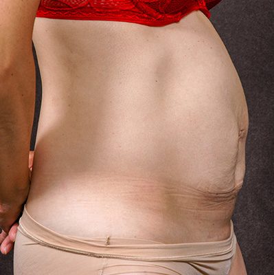Abdominoplasty before and after, case 17, view 3 (before)