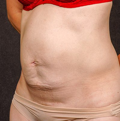 Abdominoplasty before and after, case 17, view 4 (before)