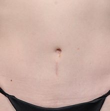 Abdominoplasty before and after, case 19 (after)