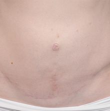 Abdominoplasty before and after, case 19 (before)