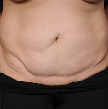 Abdominoplasty before and after, case 21 (before)