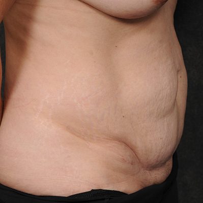 Abdominoplasty before and after, case 21, view 3 (before)