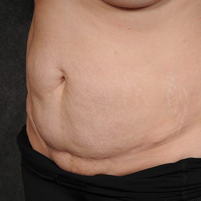 Abdominoplasty before and after, case 21, view 4 (before)