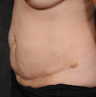 Abdominoplasty before and after, case 21, view 5 (before)