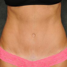Abdominoplasty before and after, case 22 (after)