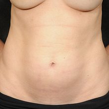 Abdominoplasty before and after, case 22 (before)