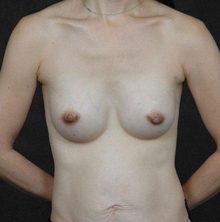 Breast Augmentation before and after, case 03 (after)