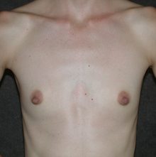 Breast Augmentation before and after, case 11 (before)