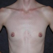 Breast Augmentation before and after, case 26 (before)