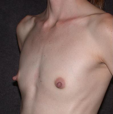 Breast Augmentation before and after, case 26, view 4 (before)