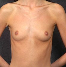 Breast Augmentation before and after, case 27 (before)
